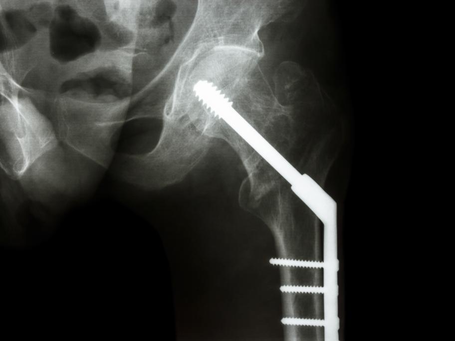 X-ray fractured hip