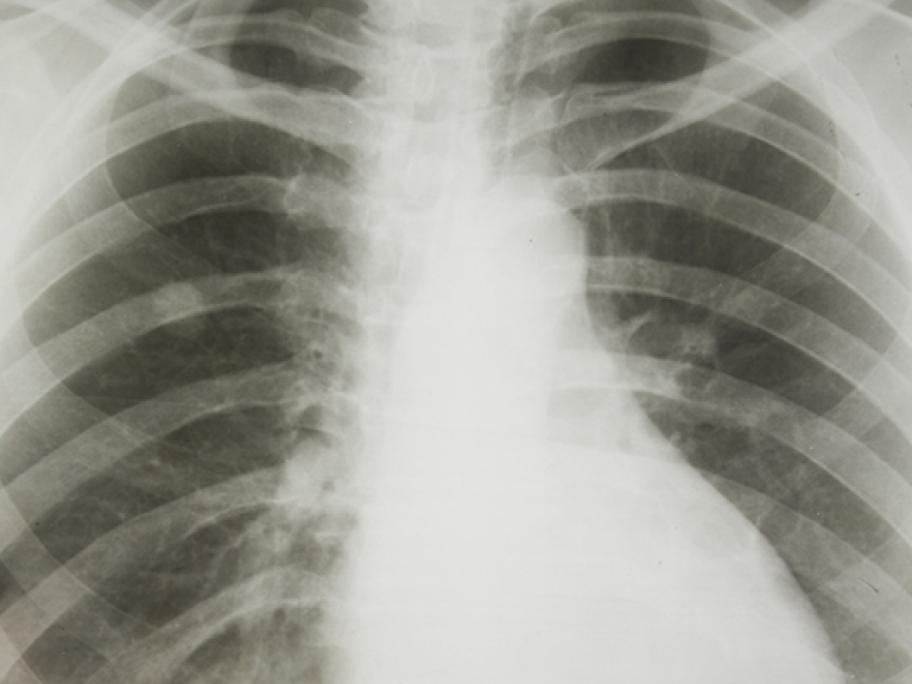 lung cancer