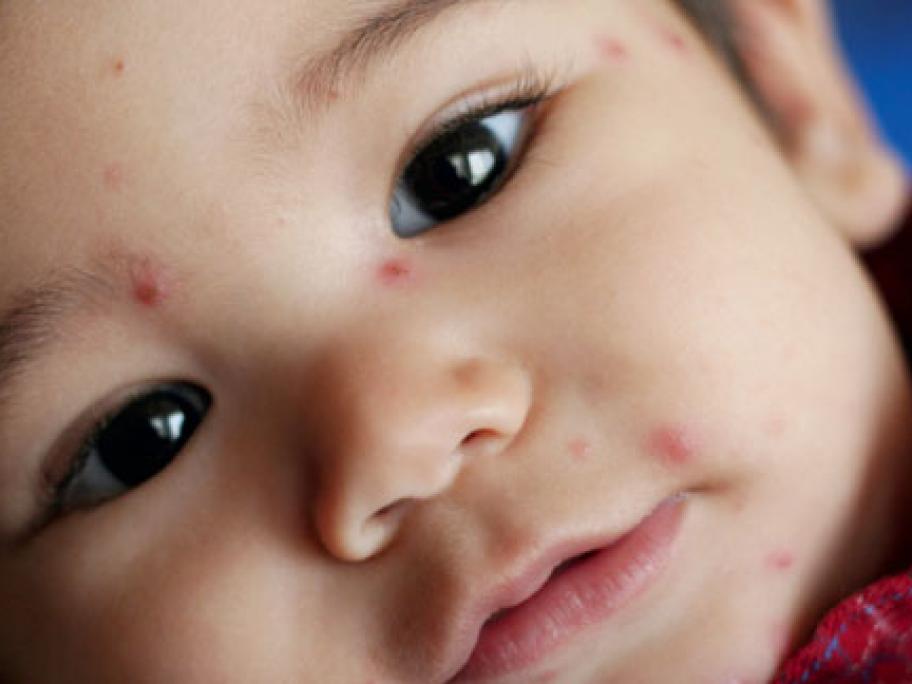 Varicella zoster in children | Australian Doctor Group